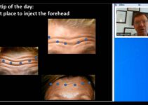 Botox Training | Injecting Forehead Properly Botox Training | Injecting Forehead Properly