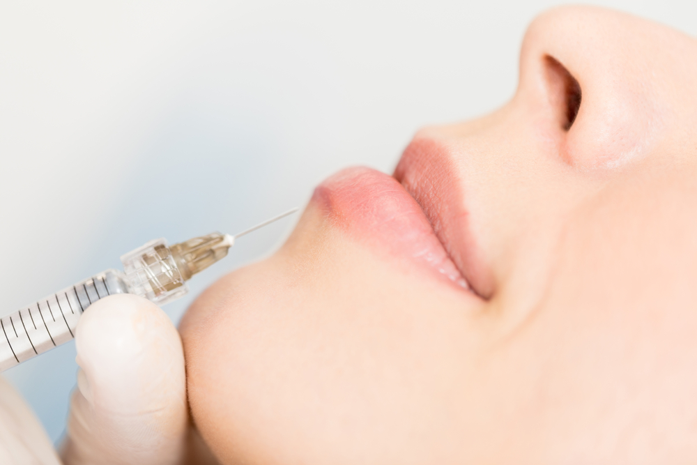 Closeup of dermal fillers being injected in lips and around the mouth to get full lips